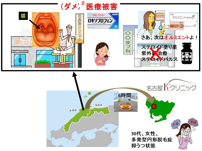 円形脱毛症　病院